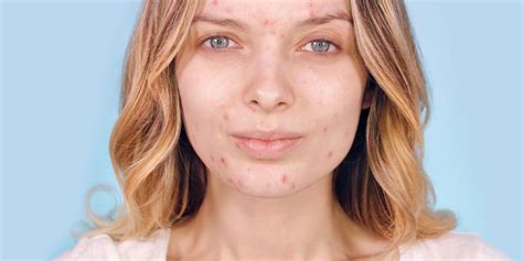 Acne: Tips for Managing - Dermatology Physicians Group Chicago Illinois