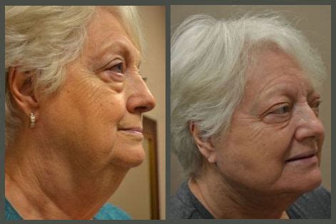 Neck Fat - Before and After Neck Lift - older female 2 - LookYounger.News