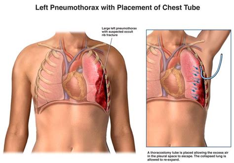 Chest Tube Pneumothorax