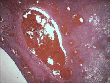 (4×, Hematoxylin and Eosin): Low power of the lesion with infarcted... | Download Scientific Diagram