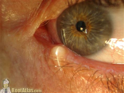 Inclusion Cysts Eyelid