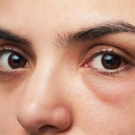 Discover more than 79 bags under eyes causes - in.duhocakina