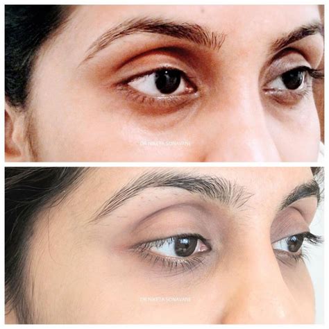 Dermal Fillers in Mumbai – Cost, Before After, Side Effects, Discount