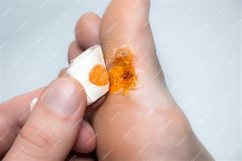 Premium Photo | Contagious skin illness on foot medical treatment photoxaclose up photo of ...