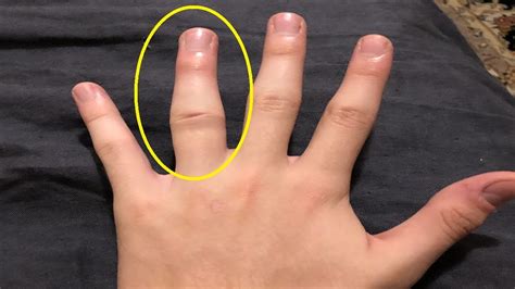 how to get rid of a jammed finger naturally - YouTube