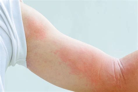 Skin Rash: 10 Causes of Skin Rashes