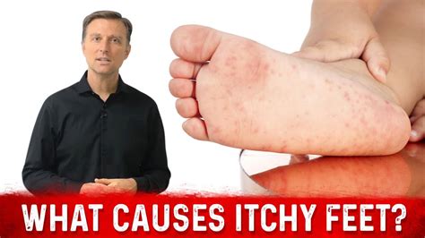 What Causes Itchy Feet and How to Stop It? – Dr. Berg - YouTube