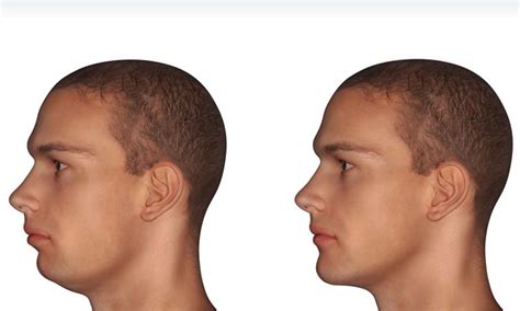 Chin Augmentation | Park Avenue Oral & Facial Surgery