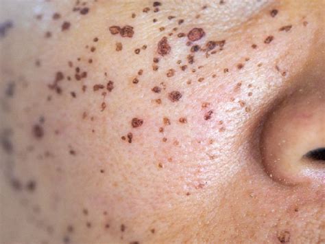 Scabs on Face: Causes, Treatment, and Prevention