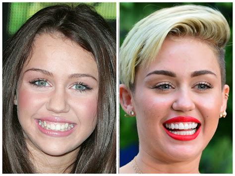 Do All Celebrities Have Veneers? Your Personal Guide on Hollywood Smile
