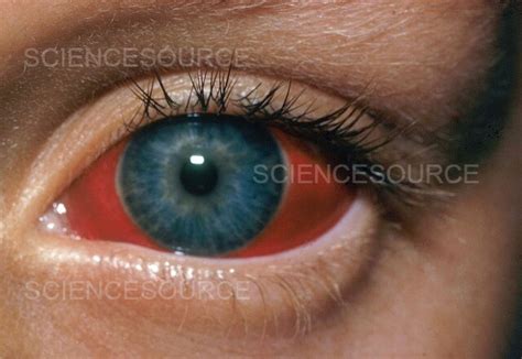 Subconjunctival Hemorrhage | Stock Image - Science Source Images