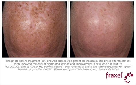 Fraxel Results - Fraxel