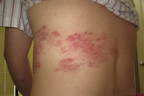 Pictures Of Shingles Rash On Body