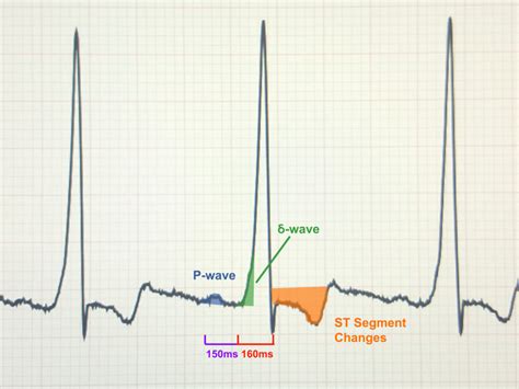 Wolff Parkinson White Syndrome - Causes, Symptoms, Treatment