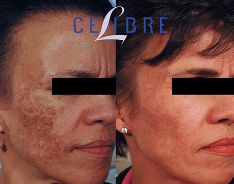 Melasma Before and After Pictures