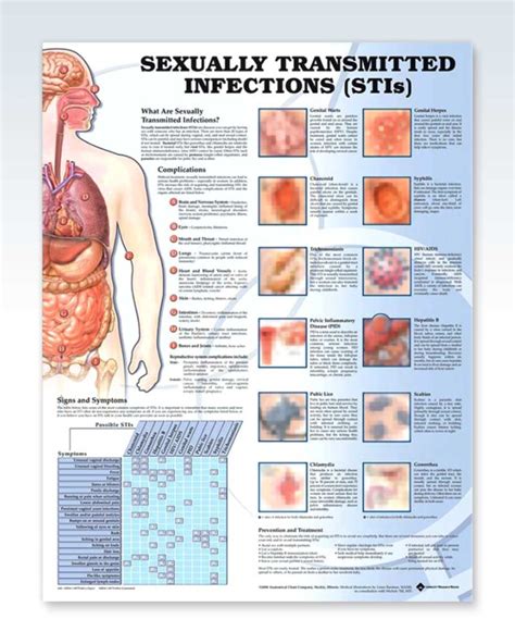 Sexually Transmitted Infections Exam Room Anatomy Poster – ClinicalPosters