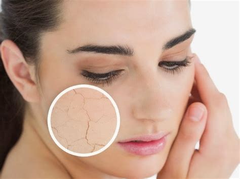 Do you know How to treat dry skin with Acne? | Dermology.us