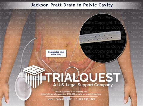 Jackson Pratt Drain in Pelvic Cavity - TrialQuest Inc.