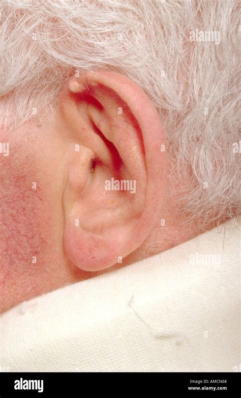 Tophus Ear