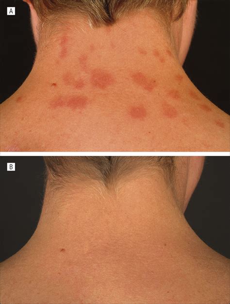 Lupus Rash On Neck And Chest