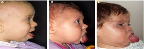 Various manifestations of macroglossia in BWS: mild (A), moderate (B ...