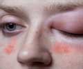 Are There Effective Treatments for Hereditary Angioedema in Children?