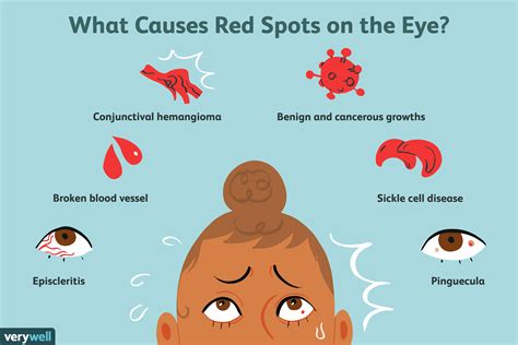 Possible Causes of a Red Spot on Your Eye