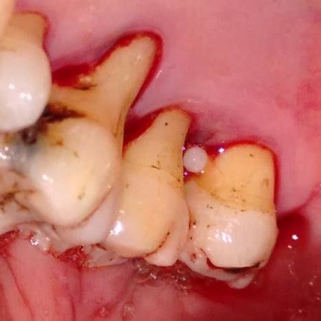 (PDF) Periodontal Management of a Case with Enamel Pearl