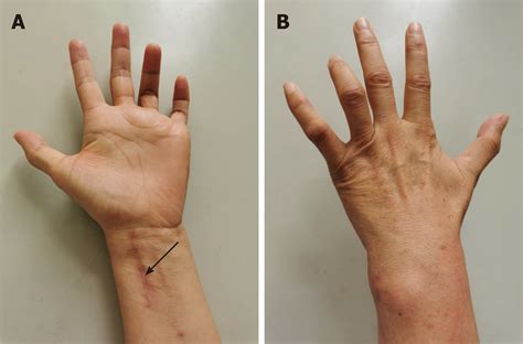 Ulnar Nerve Injury Associated With Displaced Distal R - vrogue.co