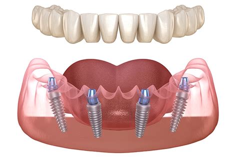 What are All-on-4 Dental Implants? - South Gables Dental