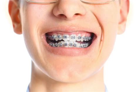 How Effective is Braces on Crooked Teeth | usiw.org