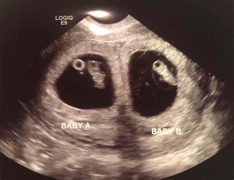 7 Week Ultrasound Identical Twins