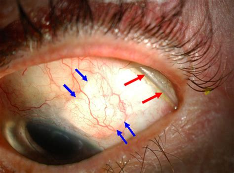 Exposed but Uninfected Scleral Buckle - The Retina Reference