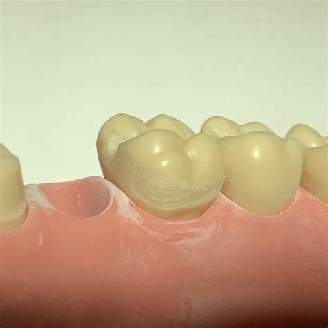 Resin bonded cantilever bridge posterior | Toothpreps