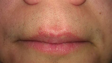 White Spots On Lips - vrogue.co