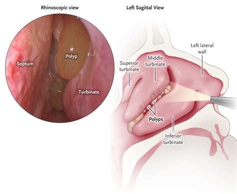 Nasal Polyps