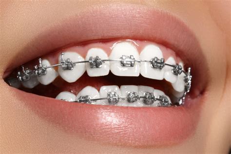 The Do's and Don'ts of Braces Care - Moles & Ferri Orthodontic Specialists