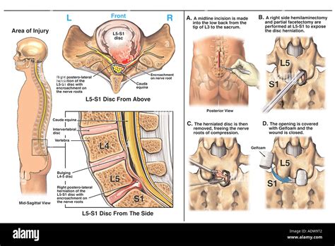 Back Surgery L5 S1 Disc Herniation with Hemilaminectomy Partial Stock Photo: 7712833 - Alamy