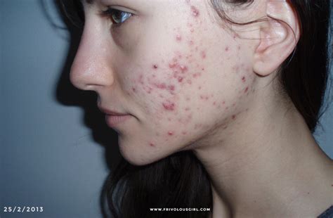 How I Cured My Cystic Acne Update: 1 Year After Probiotics