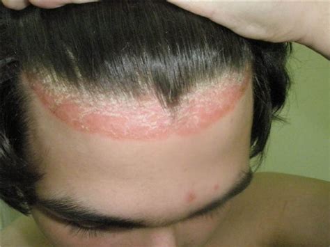 Psoriasis on face photos | Symptoms and pictures