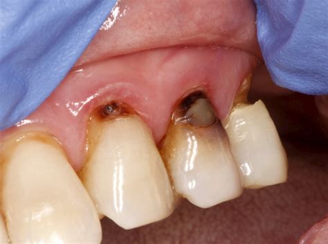 Tooth decay and 11 risk factors | Nha Khoa Bedental