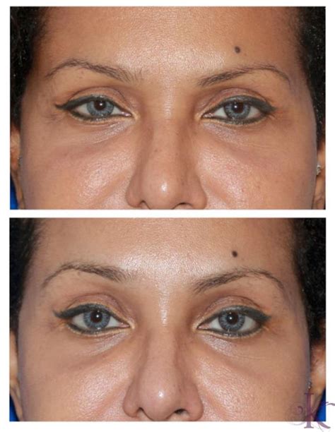 Browlift Before and After Photo Gallery | New York, NY | Konstantin Vasyukevich, MD