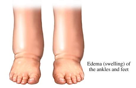 Edema | COR Medical Group