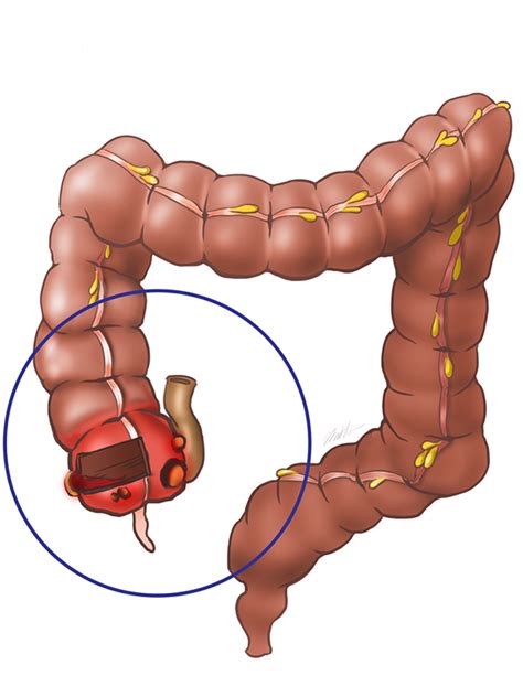 Adenocarcinoma: Cecal Adenocarcinoma