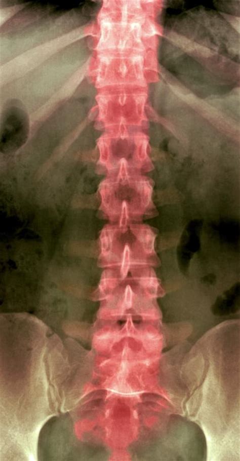 Thoracolumbar spine - retylatin