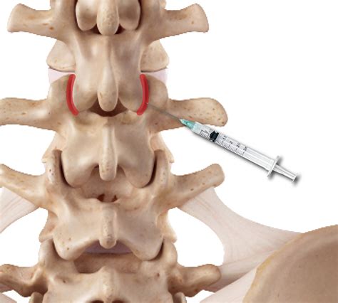 Lumbar Facet Joint Pain Symptoms / Facet Joint Injection Wikipedia ...