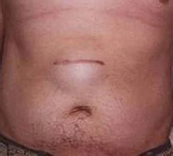 Inguinal Hernia Surgery Scar Pictures / INGUINAL HERNIA REPAIR ...