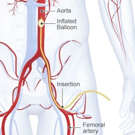 CME 25/02/16 - REBOA: Who, What, Why? by Deborah Stein - Charlie's ED