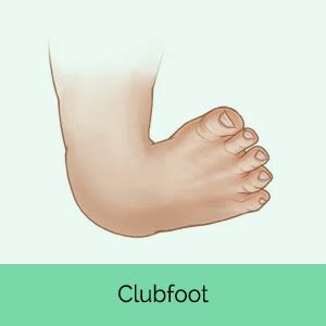 Surgical Treatment for clubfoot in Children | Posts by MD Orthopaedics ...