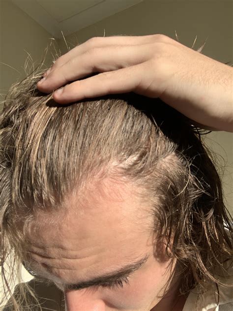 Is this past a maturing hairline? : r/malehairadvice